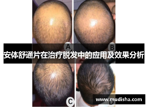 安体舒通片在治疗脱发中的应用及效果分析